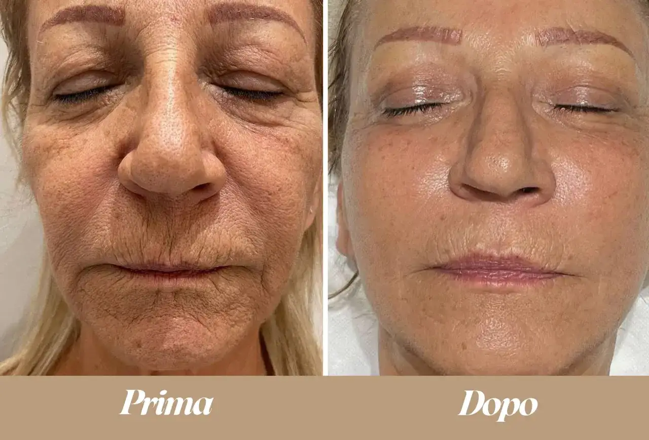 Confronto prima/dopo: il terzo superiore del viso mostra una pelle visibilmente più liscia e luminosa dopo il trattamento.