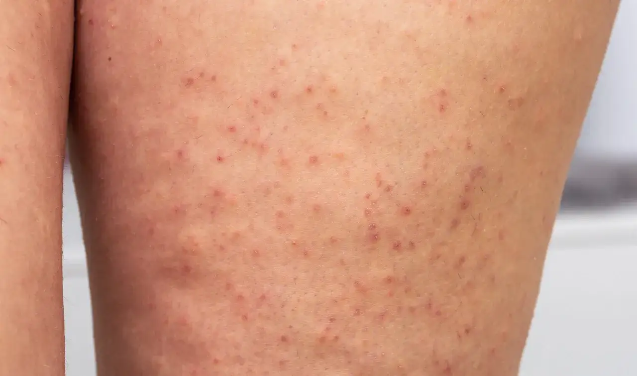 Pelle delle gambe con rossore e piccoli brufoli, tipici della follicolite. Scopri come curarla per una pelle liscia.