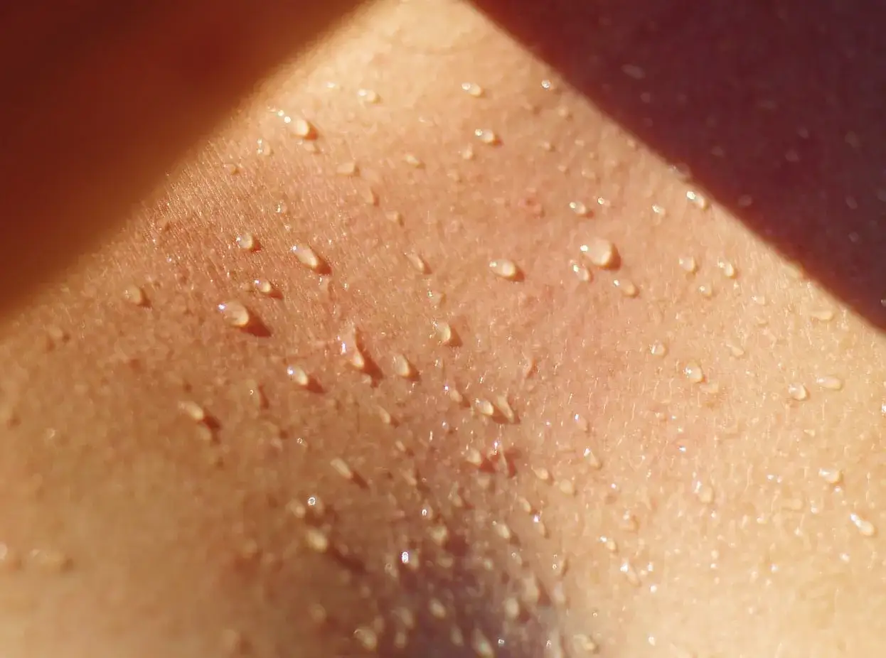Goccioline di sudore sulla pelle, un caldo abbraccio che fa venire la sudamina da prurito.