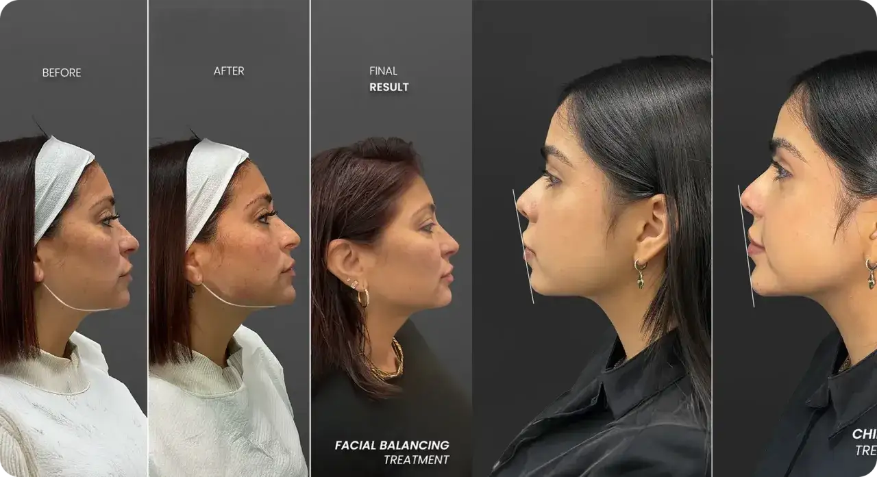 Prima e dopo: il filler mandibola quanto dura? Risultato finale di un trattamento di bilanciamento facciale.