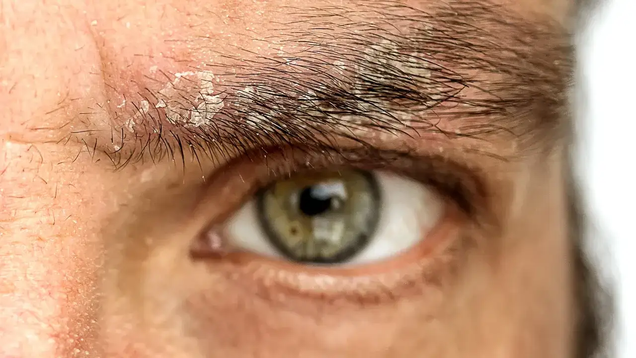 Occhio con sopracciglia che presentano squame biancastre, segno di dermatite seborroica.