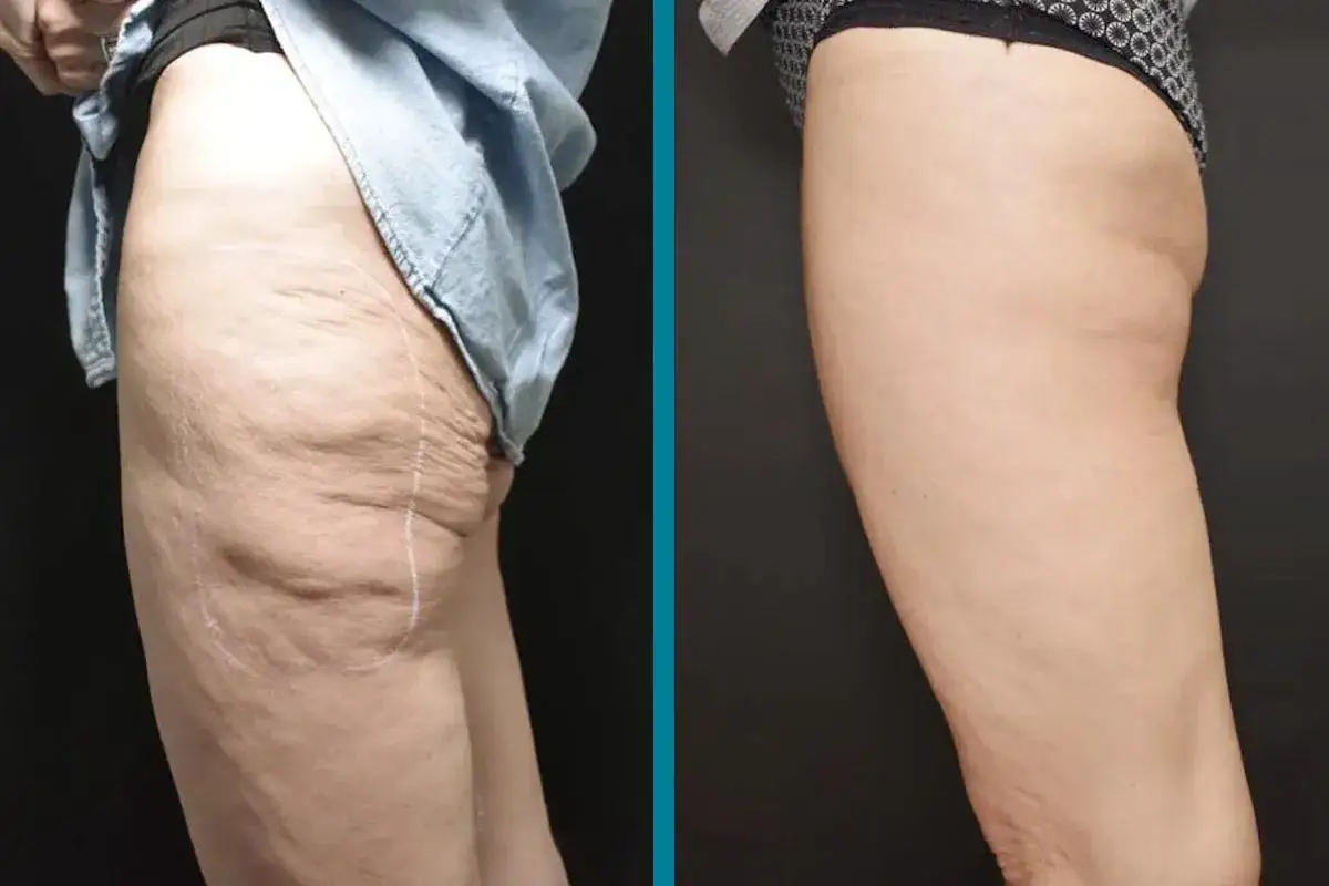 Risultati visibili di radiofrequenza glutei prima e dopo: pelle più liscia e tonica.