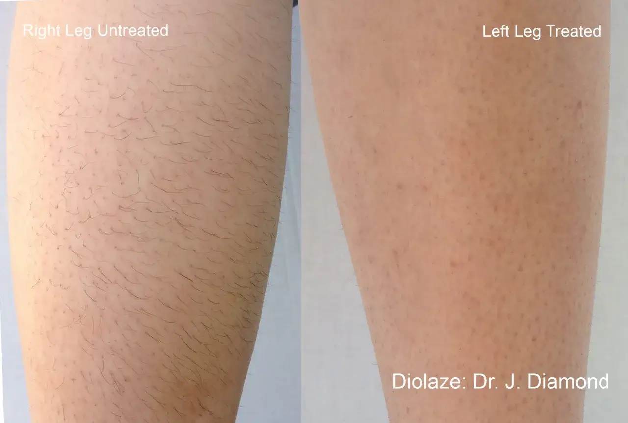Gamba destra non trattata con peli visibili, gamba sinistra trattata con laser, con meno peli. Risultato dopo quante sedute laser gambe?