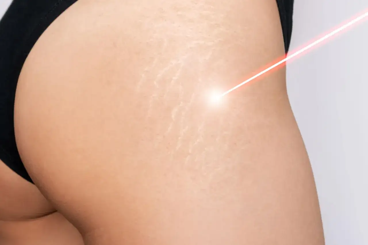 Laser treatment on skin with smagliature come eliminarle.