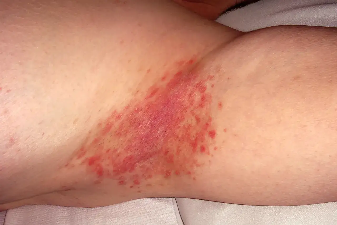 Psoriasi da stress: arrossamento e piccole lesioni cutanee nell'incavo di una piega cutanea, forse ascellare o inguinale.
