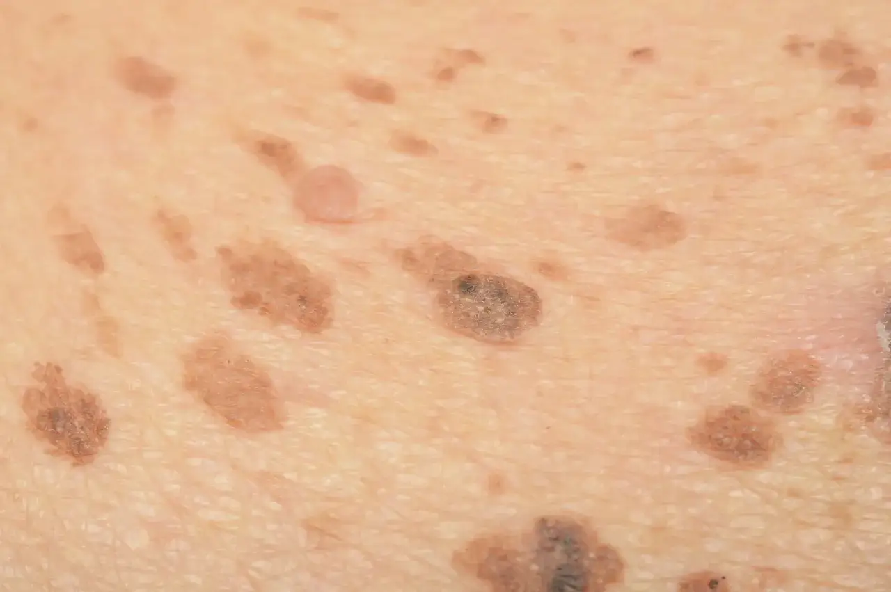 Primo piano della pelle con cheratosi seborroica. Diverse macchie marroni e una papula chiara. Si valuta la cheratosi seborroica rimozione a casa.