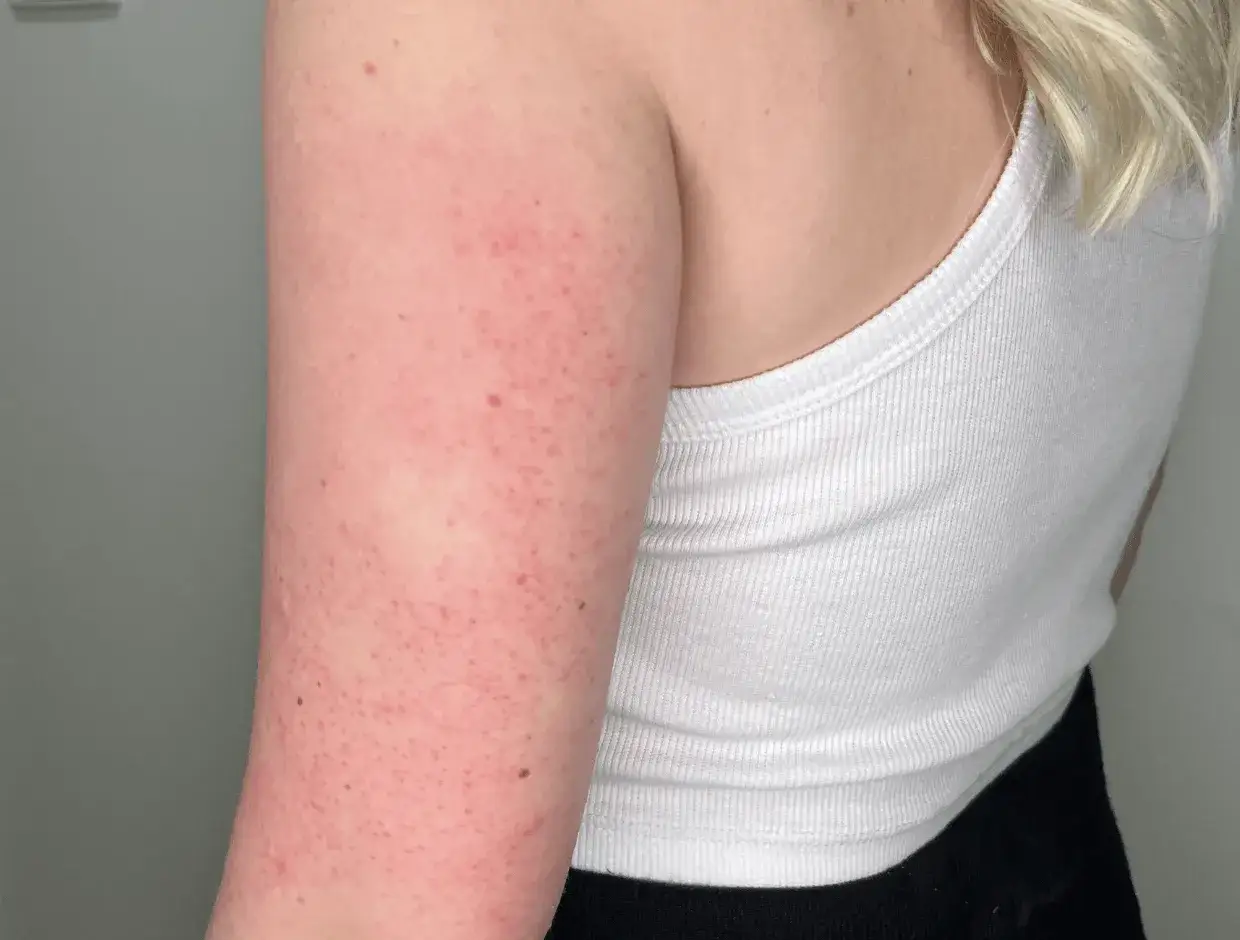 Braccio con cheratosi pilare, una condizione cutanea comune. Scopri come curarla per una pelle pi&ugrave; liscia.