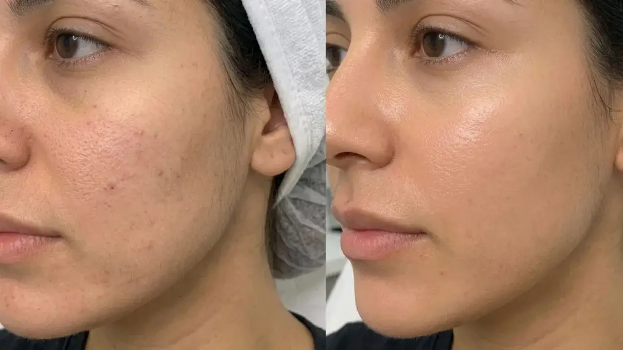 Prima e dopo biorivitalizzazione viso: pelle luminosa, pori ridotti e incarnato uniforme.