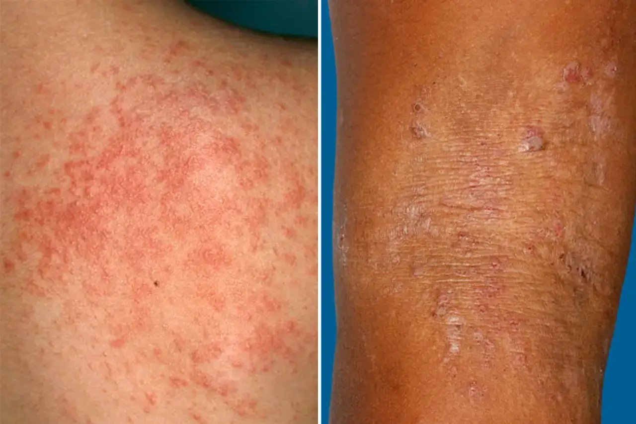 Eruzione cutanea rossa e pruriginosa, possibile allergia al sudore. La pelle appare irritata con piccole vescicole e arrossamenti.