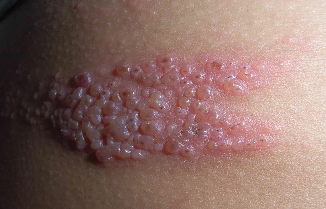 Un'eruzione cutanea con micro bollicine sulla pelle, arrossata e infiammata, che sembrano formare un grappolo.