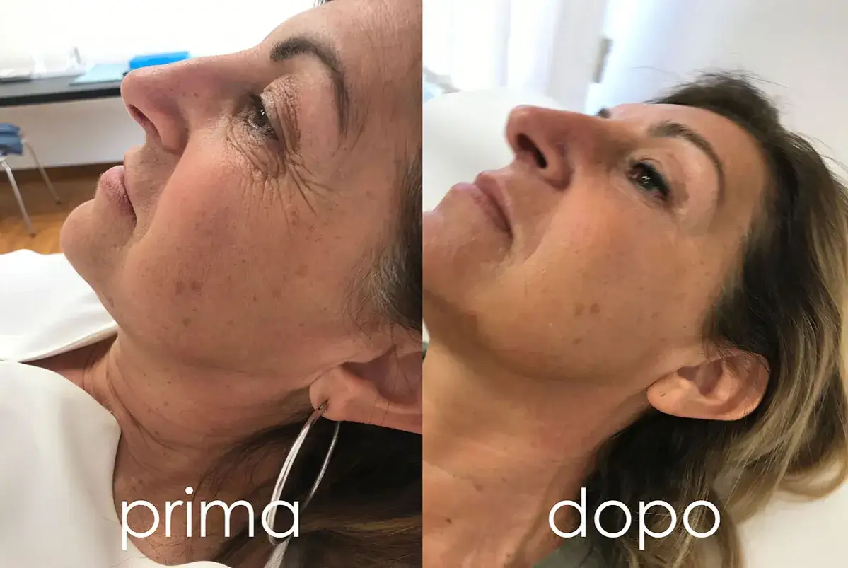 Prima e dopo un trattamento di laser ablativo viso: rughe ridotte e pelle pi&ugrave; liscia.