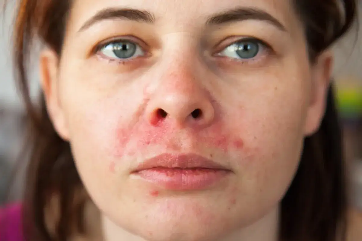 Primo piano del viso di una donna con lieve dermatite seborroica, arrossamento e piccole lesioni intorno al naso e alla bocca.