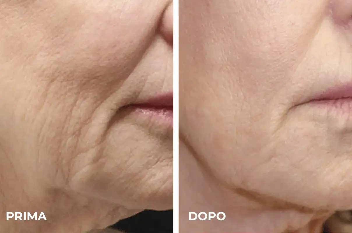 Prima e dopo un trattamento laser viso rughe: la pelle appare visibilmente pi&ugrave; liscia e giovane.