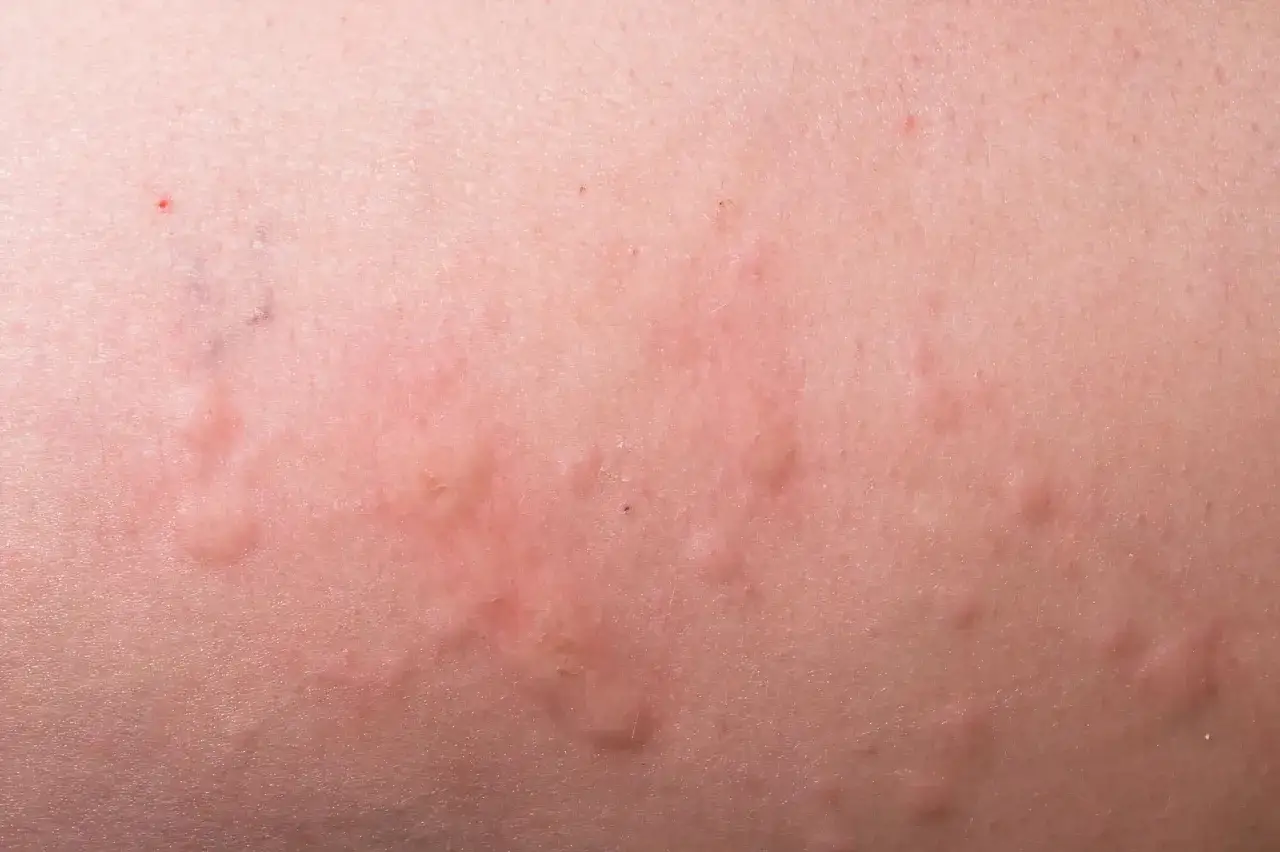 Pelle arrossata con pomfi pruriginosi, possibili manifestazioni di dermatite da stress.
