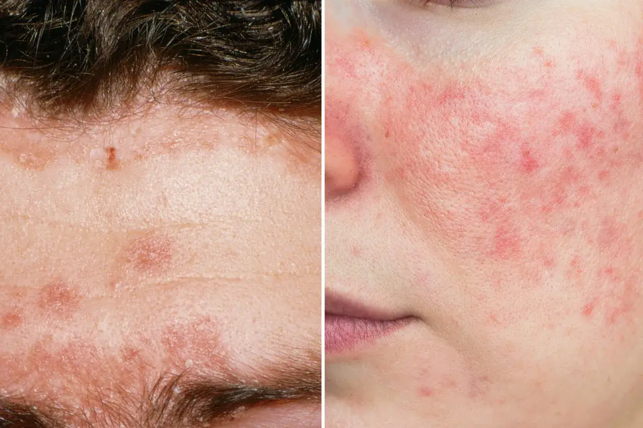 Dermatite seborroica fronte: chiazze rosse e squamose sulla pelle, con un'area di arrossamento e pustole sul viso.