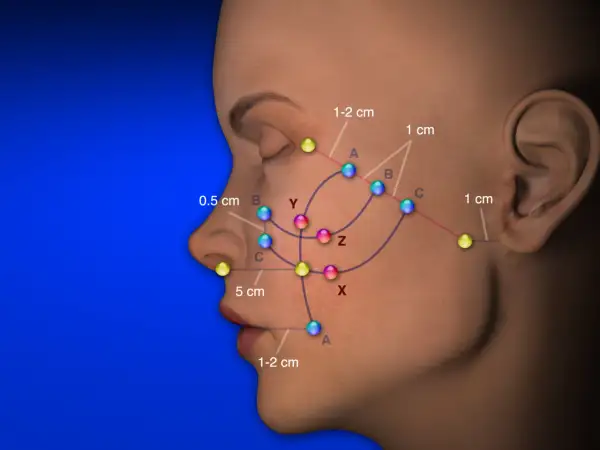 Punti riassorbibili colorati indicano aree di trattamento sul viso, con distanze misurate.