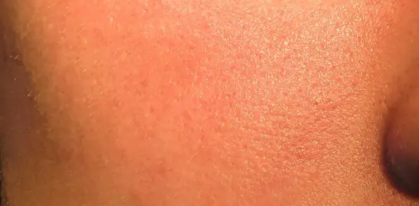 Pelle arrossata e secca, con piccole scaglie visibili, possibili effetti collaterali del retinolo.