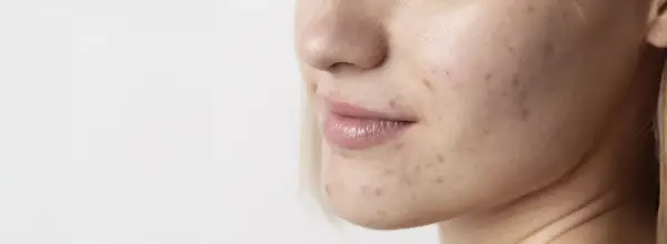 Primo piano del viso di una giovane donna con segni di acne. La pelle mostra imperfezioni, rossori e brufoli, evidenziando la necessità di una **pulizia viso acne**.