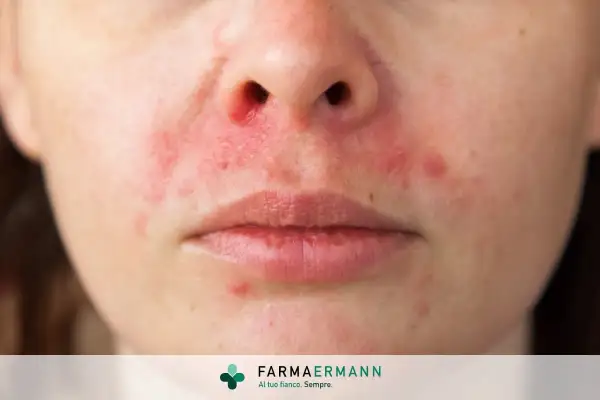 Viso arrossato e irritato, con piccole pustole e zone squamose, indicative di lieve dermatite seborroica viso.