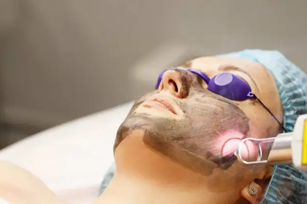 Donna con maschera al carbone per un trattamento laser. Il carbon peel prima e dopo trasforma la pelle.
