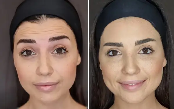 Confronto tra fronte con rughe e fronte levigata, mostrando la differenza tra botox e filler.