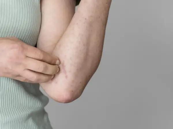 Braccio con eritema e puntini rossi, segno di possibile allergia al sudore.