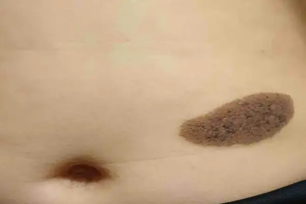 Macchia marrone sulla pelle tipo bruciatura, con una texture ruvida e irregolare, vicina all'ombelico.