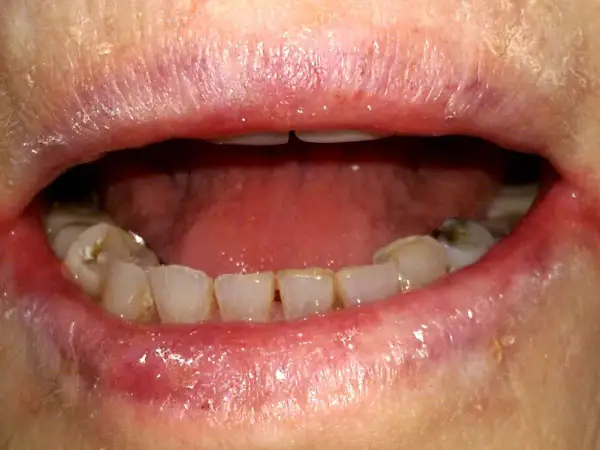 Labbra arrossate e screpolate, con segni di cheilite angolare agli angoli della bocca. Denti visibili, alcuni con macchie.