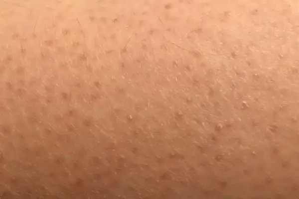 Pelle con cheratosi pilare, piccoli puntini rossi e peli incarniti. Scopri come curarla.