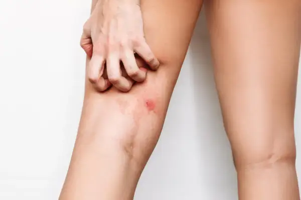 Mano che si gratta la coscia irritata, cercando rimedi naturali per lo sfregamento cosce.