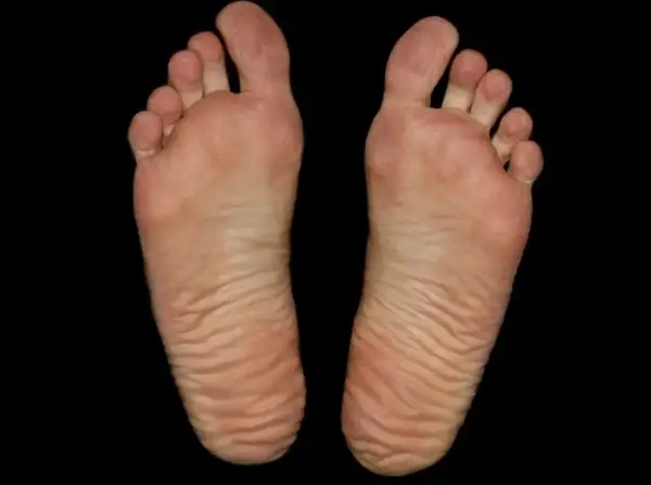 Piante dei piedi con dita separate e pelle rugosa, un segno di camminate lunghe, forse un occhio di pernice in formazione.