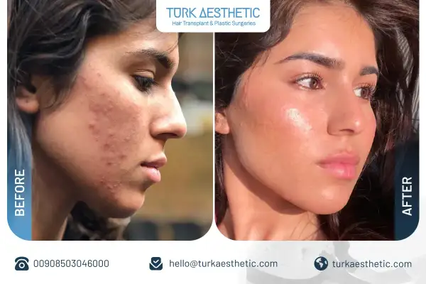 Prima e dopo laser CO2: pelle con acne trasformata in viso luminoso e senza imperfezioni.