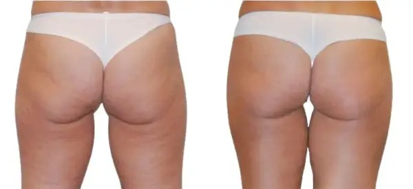 Confronto radiofrequenza glutei prima e dopo: pelle più liscia e tonica.