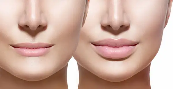 Prima e dopo: labbra più piene e definite, un esempio di come rimpolpare le labbra in modo naturale per un sorriso radioso.