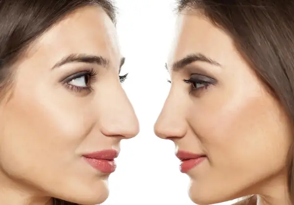 Profilo di due donne, una con naso più pronunciato, l'altra con naso modificato. Attenzione al rinofiller rischio cecità.