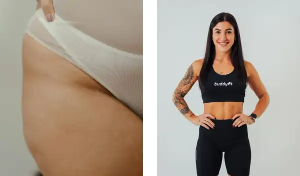 Dettaglio di culotte de cheval, causa di inestetismi della pelle, accanto a una donna sorridente in abbigliamento sportivo.