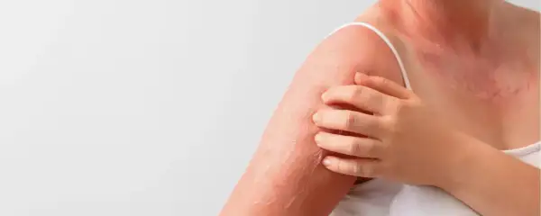 Spalla e collo arrossati con desquamazione, segno di cheratosi della pelle. La mano sfiora la zona irritata.