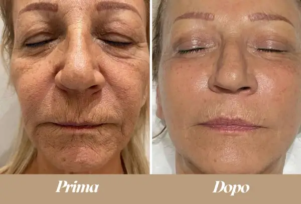 Confronto prima/dopo: il terzo superiore del viso mostra una pelle più liscia e luminosa dopo il trattamento.
