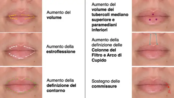 Esempi di filler labbra fatto male: labbra gonfie, asimmetriche o con contorni innaturali. Illustrazioni mostrano correzioni.
