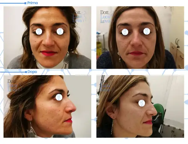 Prima e dopo un trattamento di laser ablativo viso per migliorare la texture della pelle e ridurre le imperfezioni.